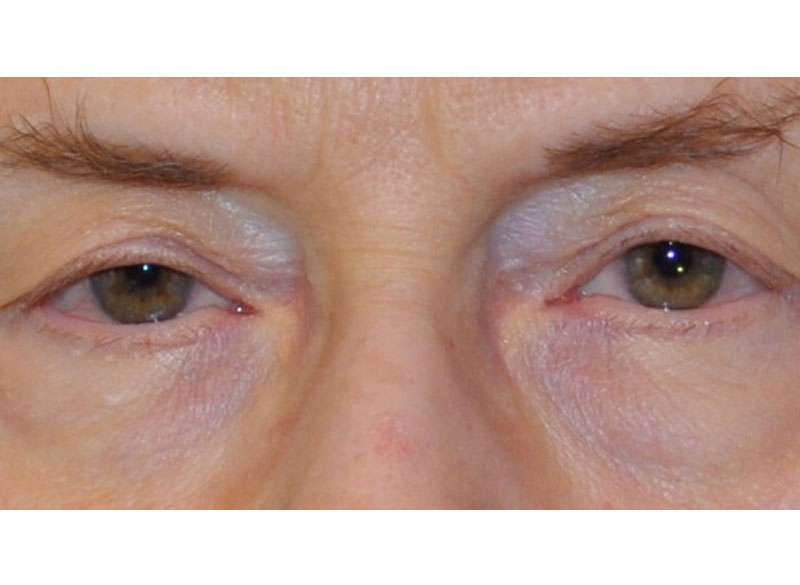 Blepharoplasty Chicago | Upper and Lower Eyelid Lift Surgery