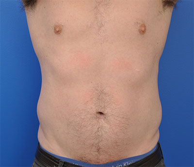 Male Body Contouring Before and After