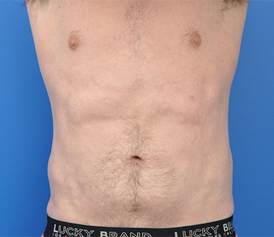 Male Body Contouring Before and After