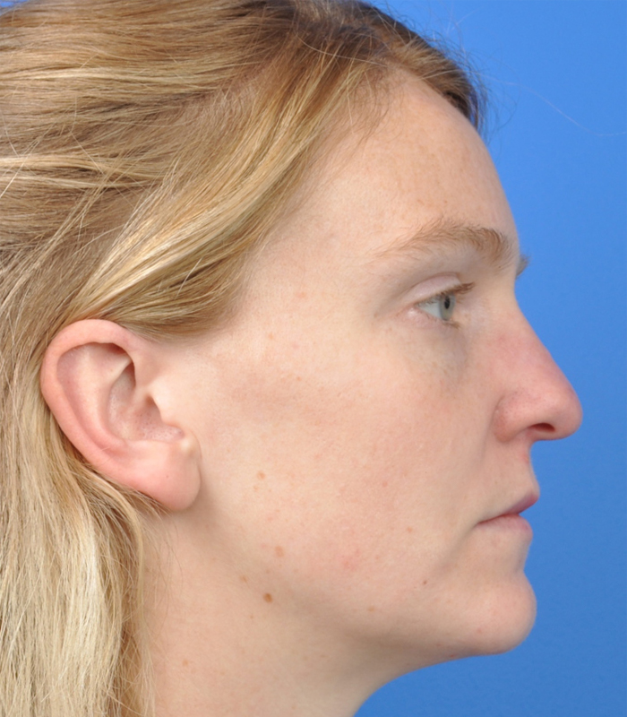 Rhinoplasty