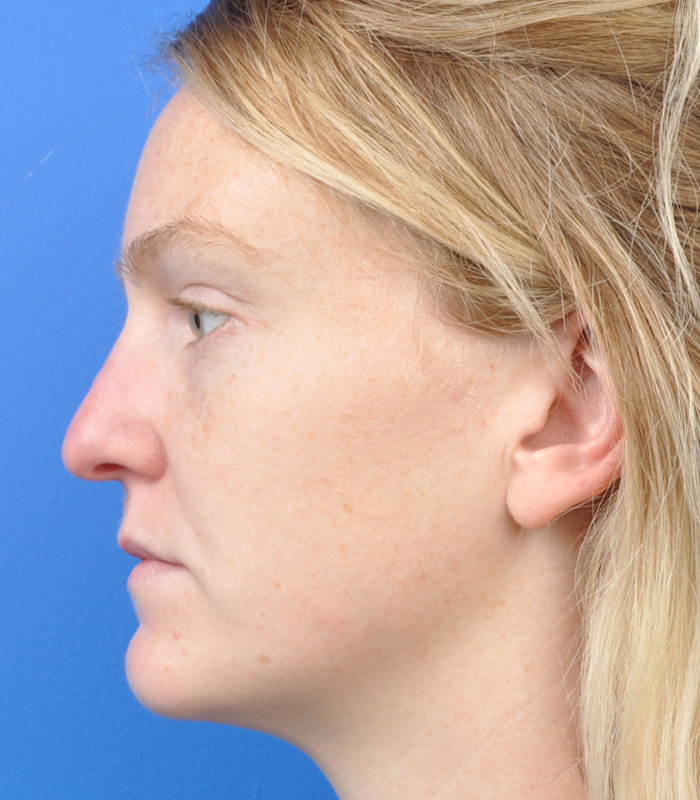 Rhinoplasty