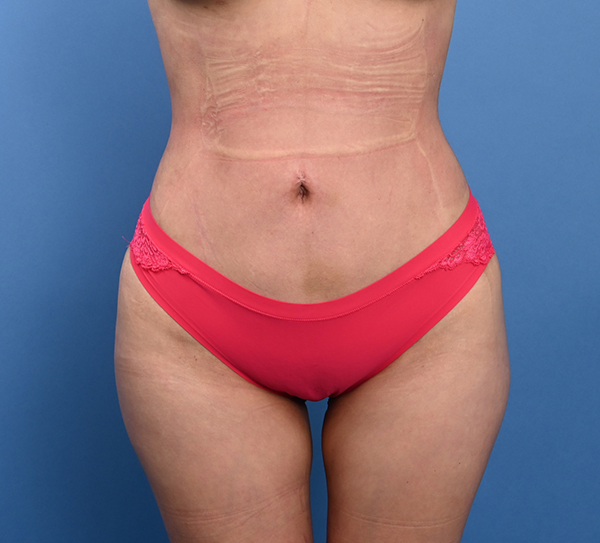 Liposuction Before and After Results Chicago