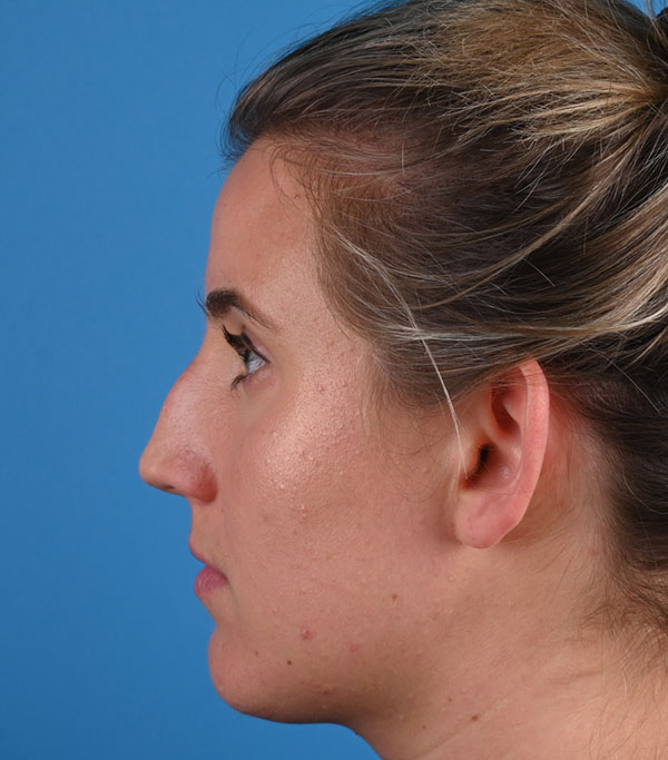 Rhinoplasty