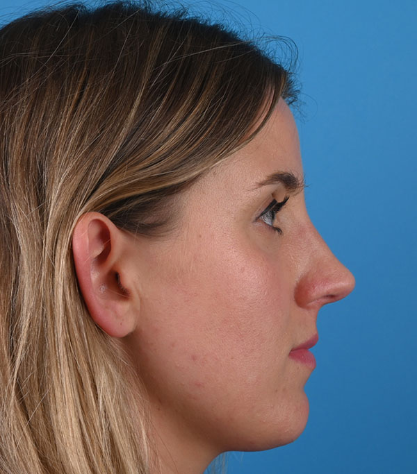 Rhinoplasty