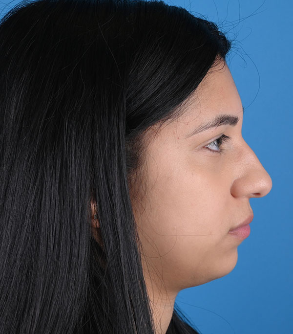 Rhinoplasty