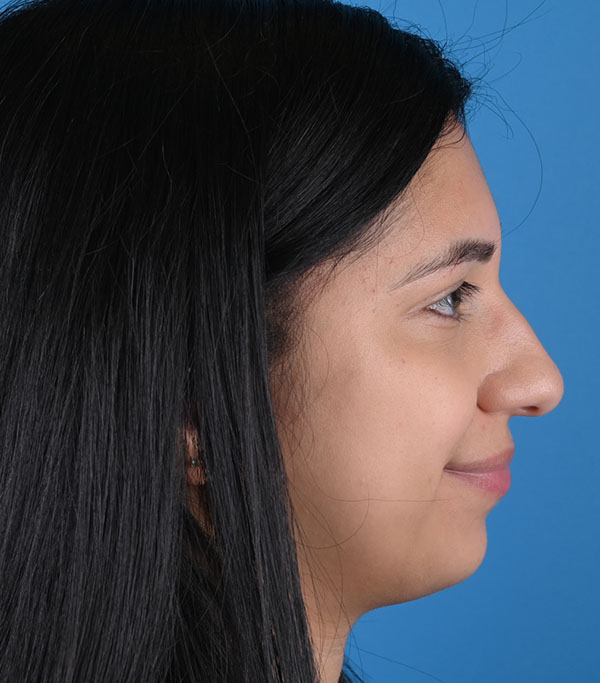 Rhinoplasty