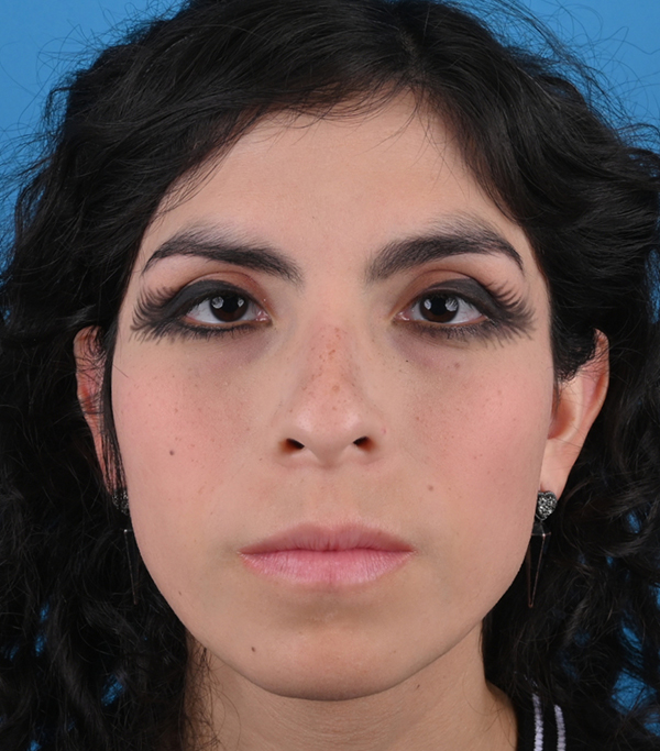 Rhinoplasty