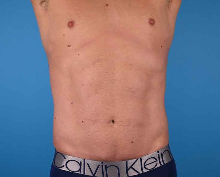 Male Abdominal Etching