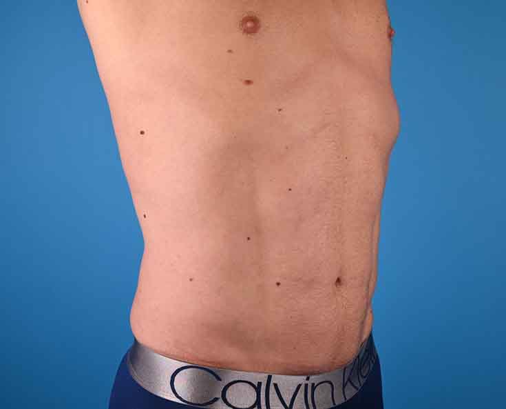 Male Abdominal Etching