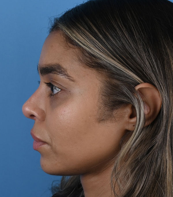 Ethnic Rhinoplasty