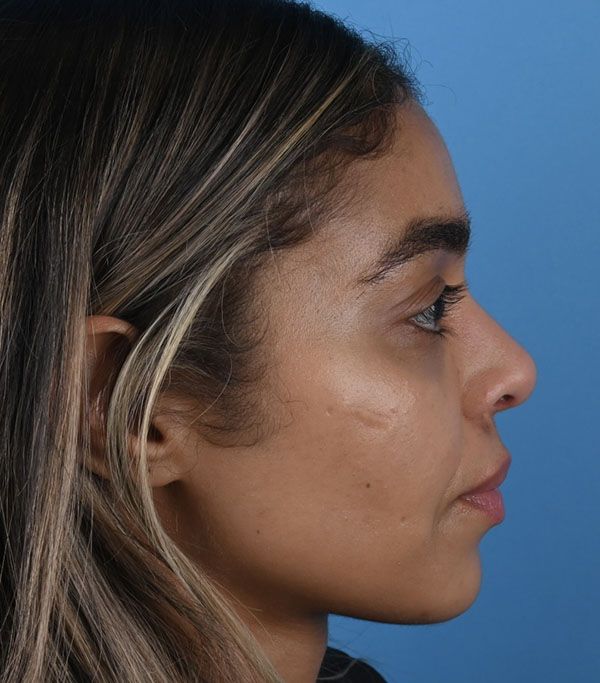 Ethnic Rhinoplasty