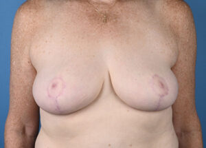 Breast Reduction