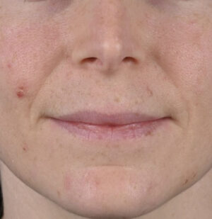 Lip Augmentation