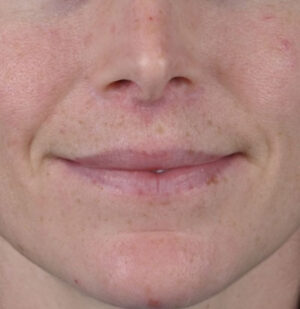 Lip Augmentation