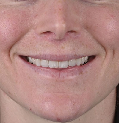 Lip Augmentation