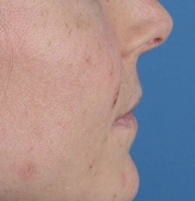 Lip Augmentation