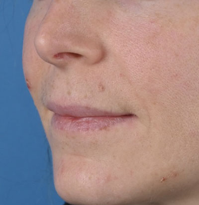 Lip Augmentation