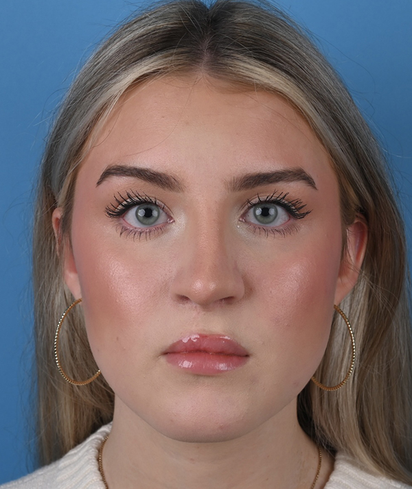 Revision Rhinoplasty