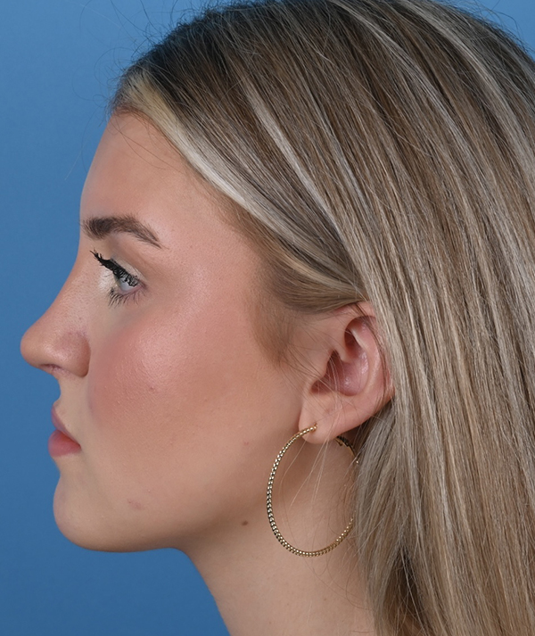 Revision Rhinoplasty