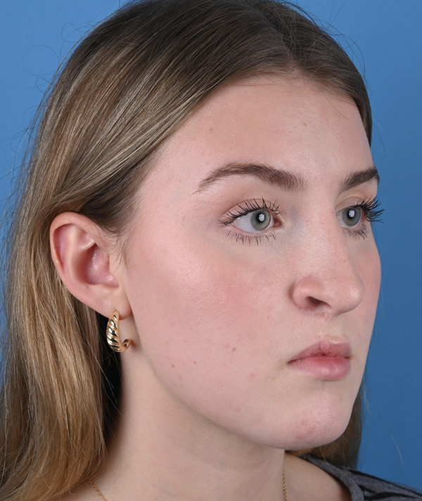 Revision Rhinoplasty