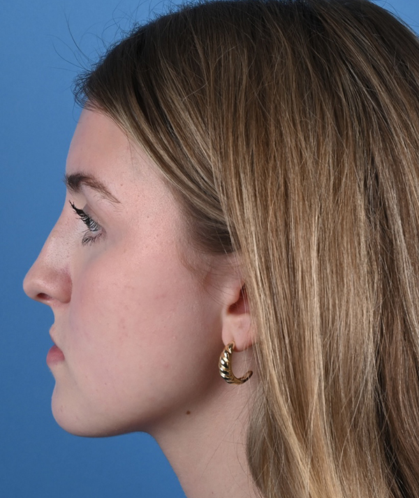 Revision Rhinoplasty