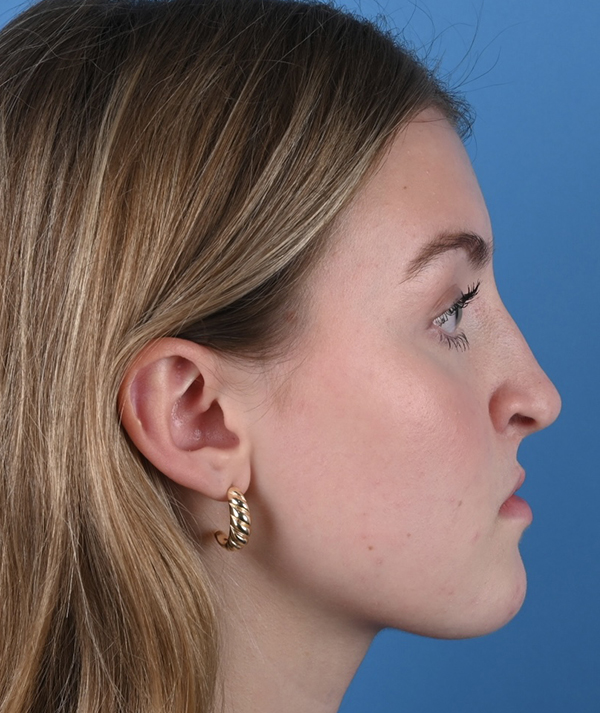 Revision Rhinoplasty