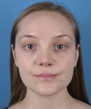 Cleft Rhinoplasty