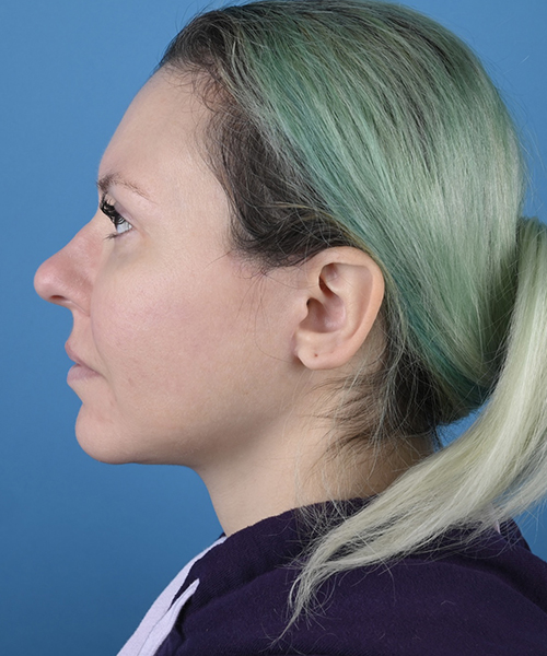 Facelift